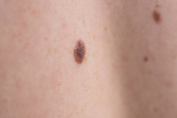 What Is the Recovery Time for Skin Tag Removal Procedures