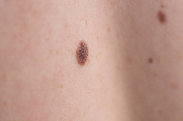 What Is the Recovery Time for Skin Tag Removal Procedures