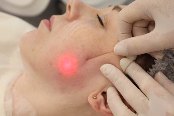 What Results Can You Expect From Endolift Treatments