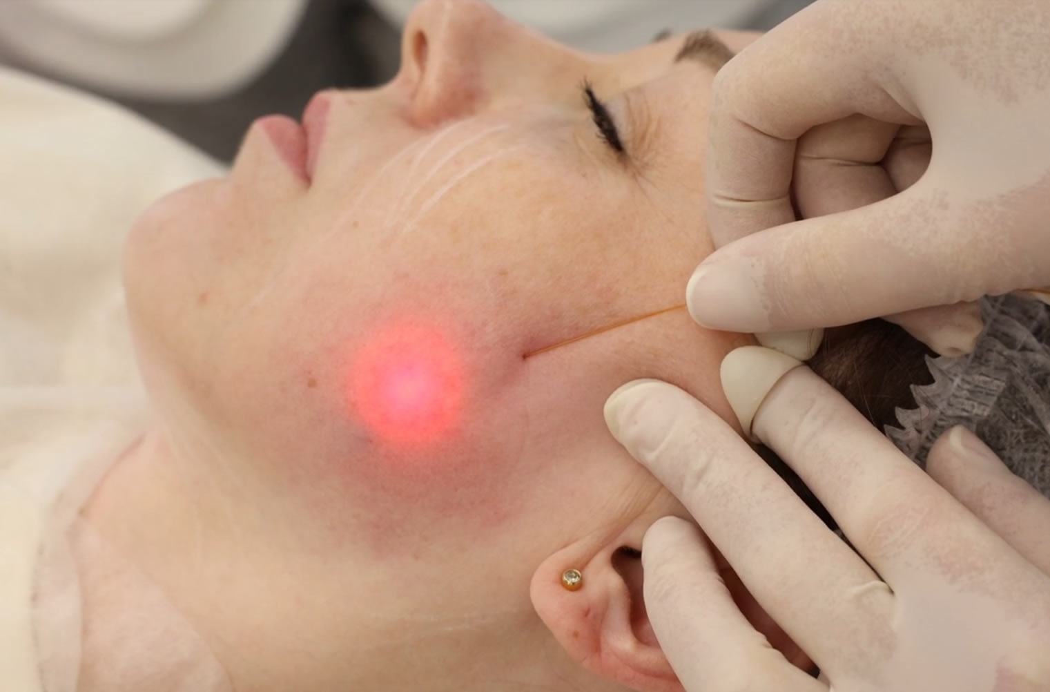 What Results Can You Expect From Endolift Treatments