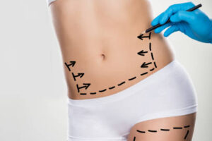 Who Is the Ideal Candidate for Liposuction