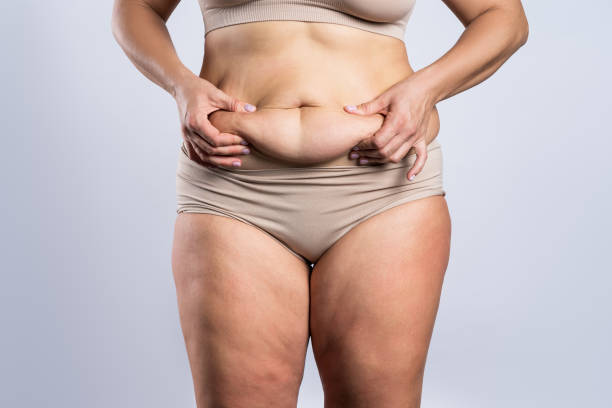 Why Choose CoolSculpting for Fat Reduction Needs
