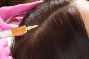 exosomes hair therapy in Islamabad