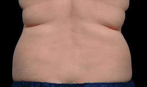 Fat freezing dubai