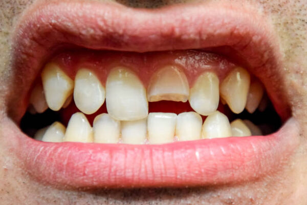 Tooth Fracture Treatment in Pakistan: Modern Dental Care, Causes, and Safe Recovery Guide