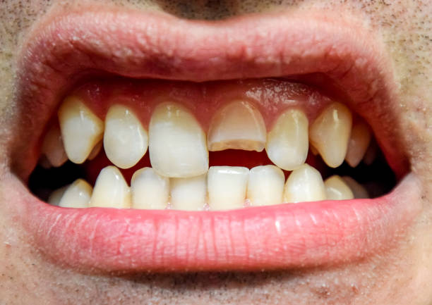 Tooth Fracture Treatment in Pakistan: Modern Dental Care, Causes, and Safe Recovery Guide