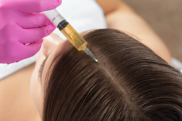 Causes, Treatment, and Solutions Dandruff and Hair Fall in Islamabad :