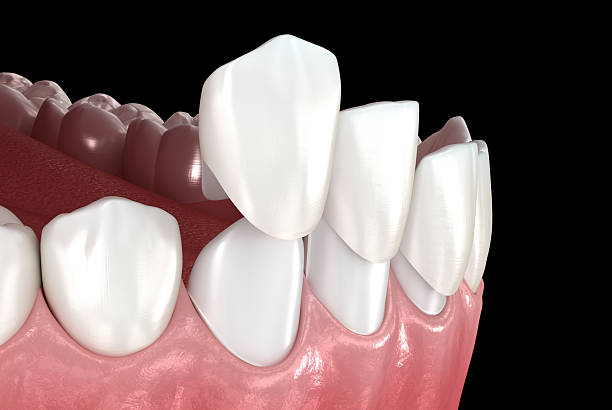 Dental Veneers in Pakistan: What to Do If You Feel Pain After Veneer Placement
