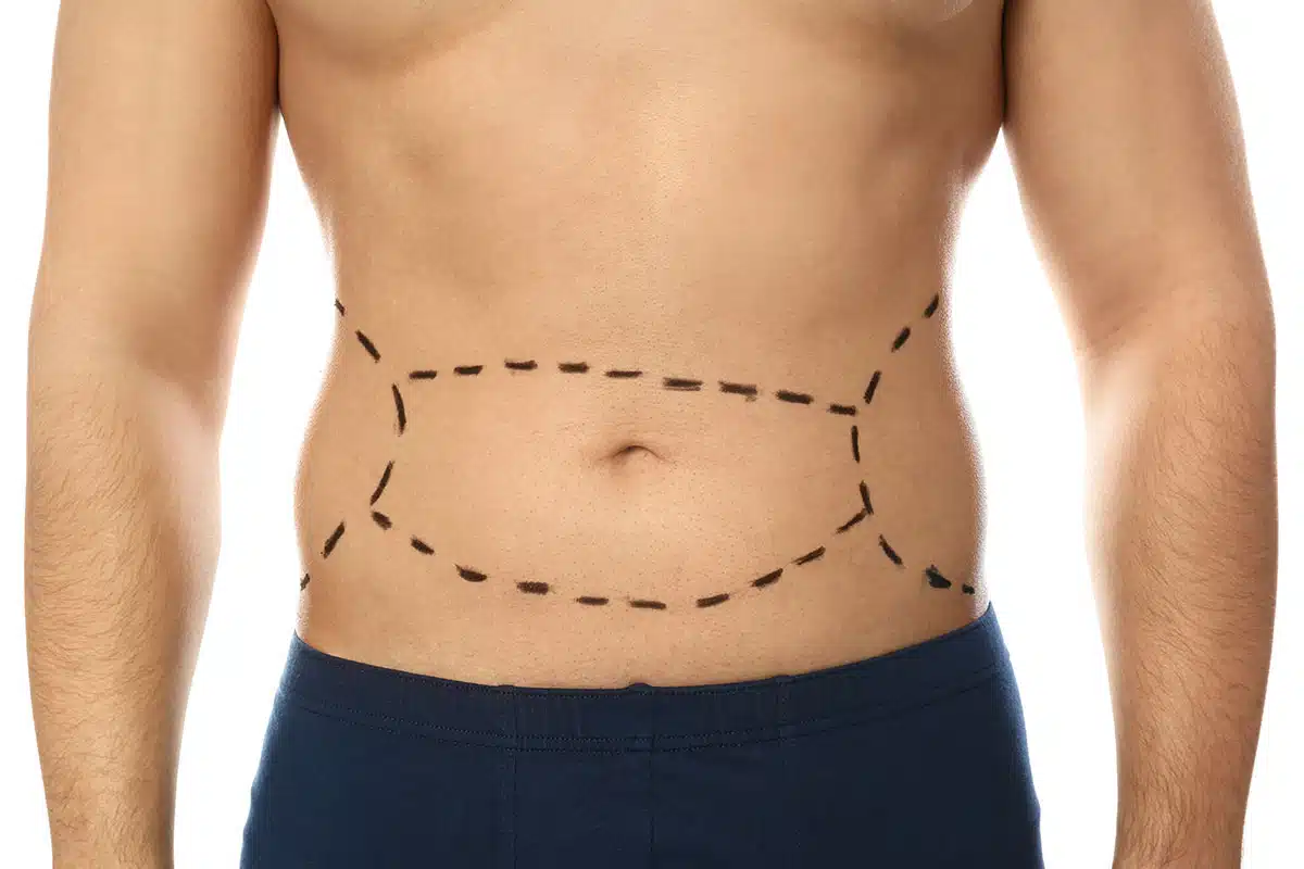 tummy tuck surgery in Islamabad
