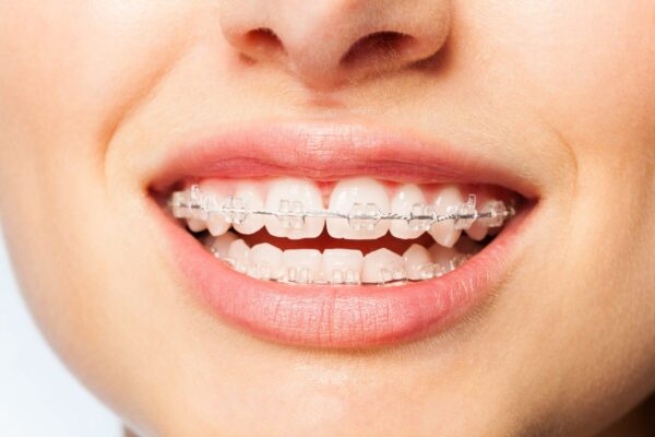braces treatment in madhapur