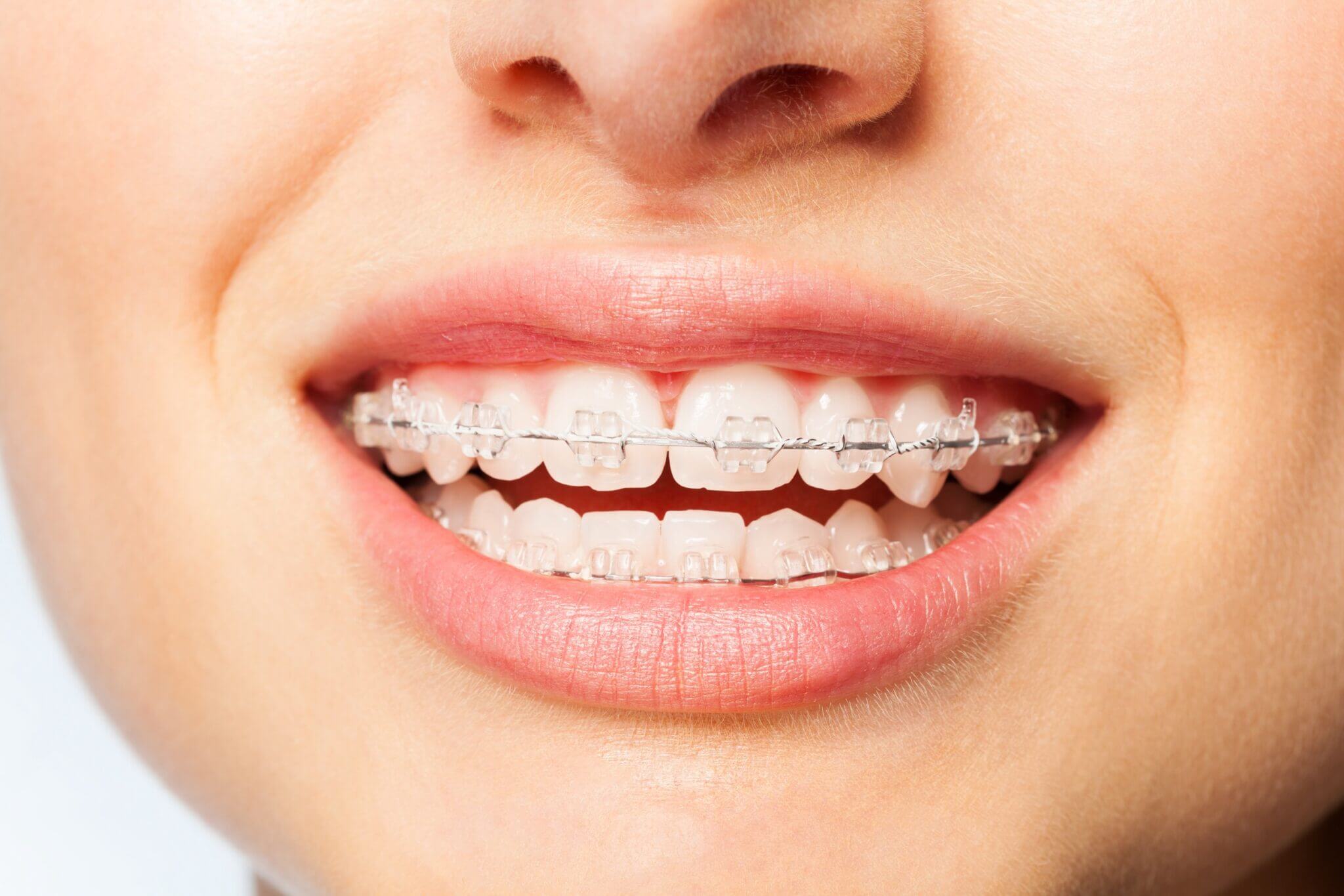 braces treatment in madhapur