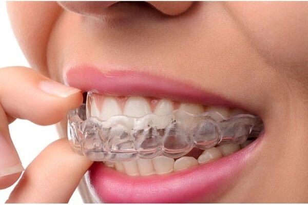 invisalign treatment in andheri west