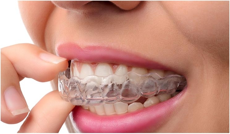 invisalign treatment in andheri west