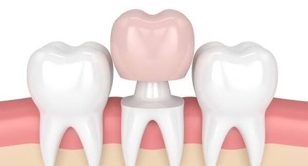 dental crown cost in madhapur