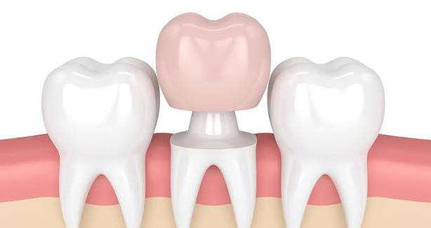 dental crown cost in madhapur