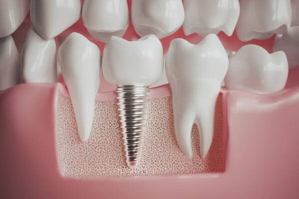 tooth replacement in jamshedpur