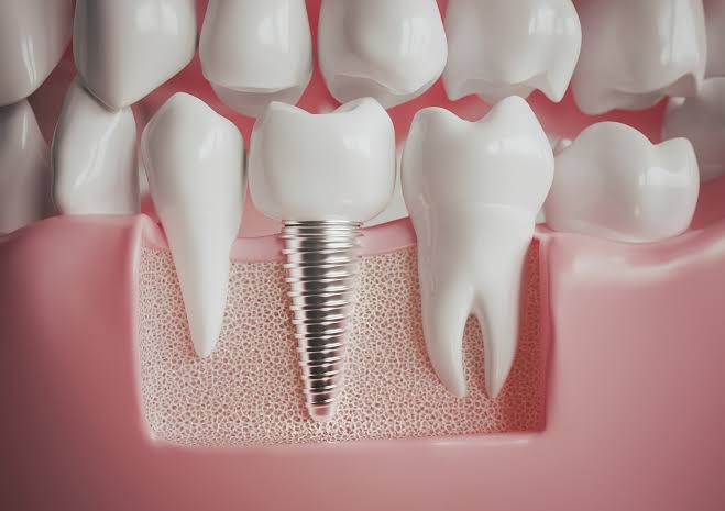 tooth replacement in jamshedpur