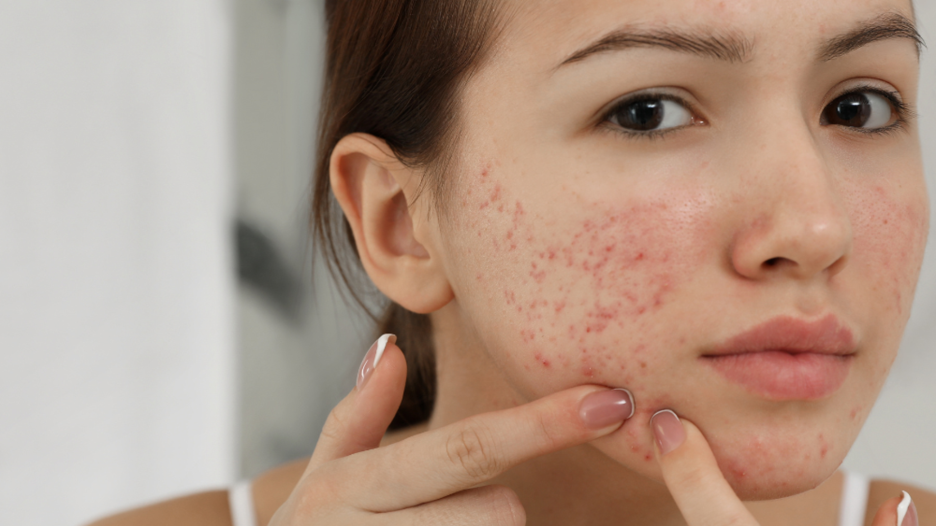 Clear Your Skin with Advanced Acne Treatment for Lasting Confidence
