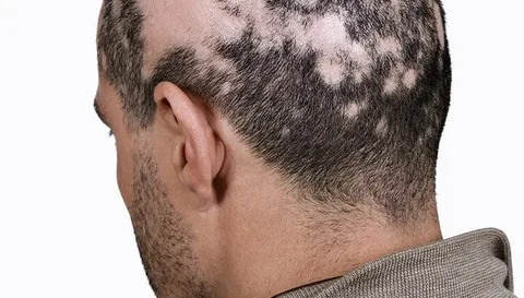 Alopecia Areata Treatment In Islamabad