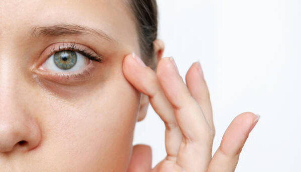 Can Blepharoplasty Correct Eye Bag Shadowing Effects