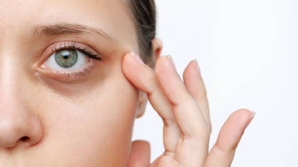 Can Blepharoplasty Correct Eye Bag Shadowing Effects