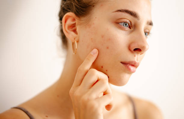 Can Laser Acne Scar Treatment Reduce Pitted Scars