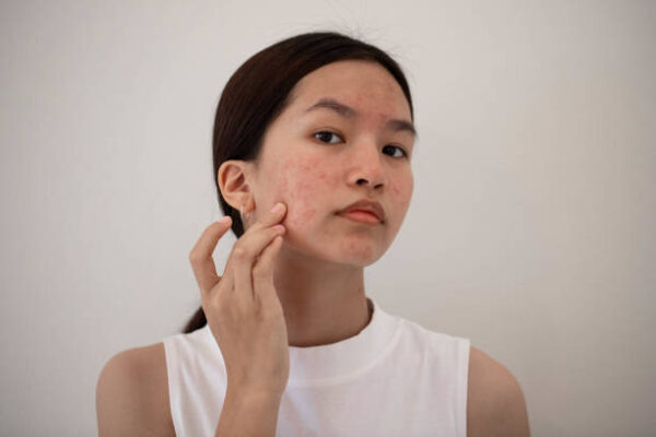 Can Laser Acne Scar Treatment Remove Old Scars