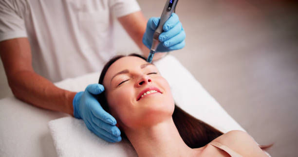 Can Microneedling for Acne Scars Help Reduce Redness on Scar Marks