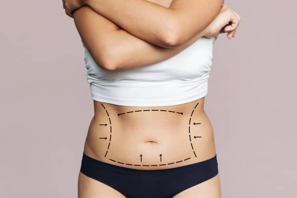 Can Mini Tummy Tuck Improve Body Confidence