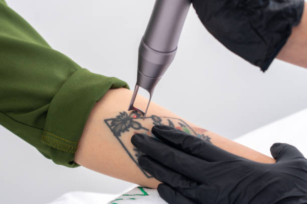 Can Old Ink Fade Faster With Laser Tattoo Removal
