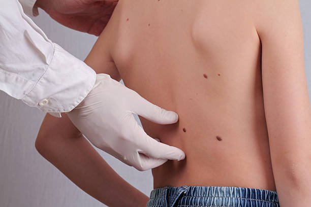 Can Skin Tag Removal Enhance Your Skin's Appearance