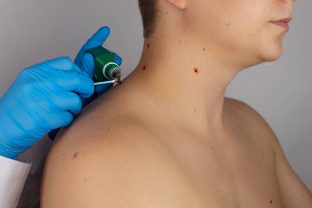Can Skin Tag Removal Enhance Your Skin's Appearance