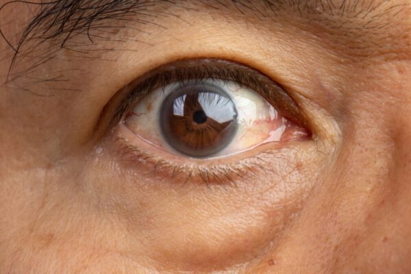 cataract surgery in chinchwad