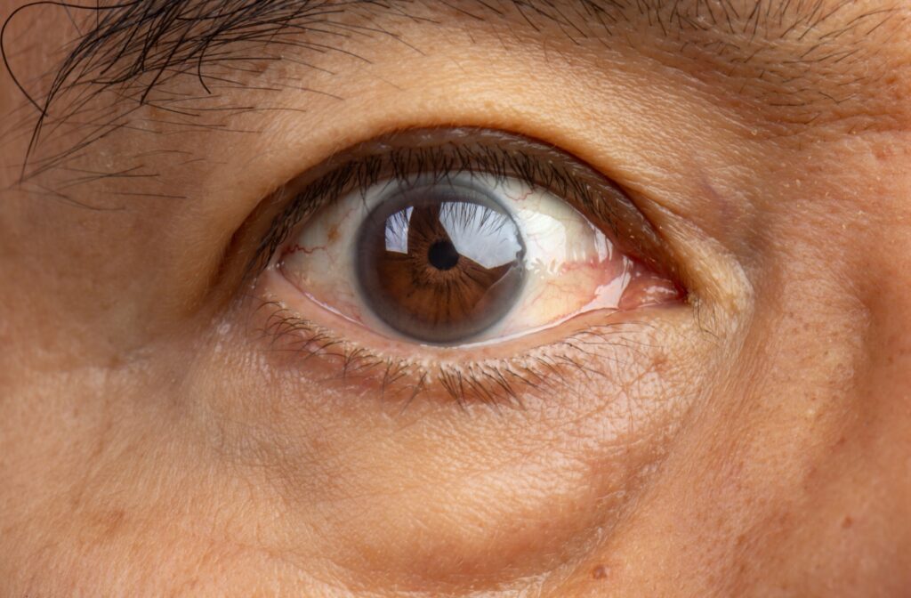 cataract surgery in chinchwad