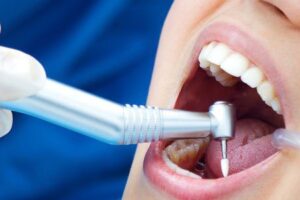 Dental Filling in Islamabad
