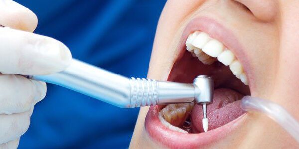 Dental Filling in Islamabad
