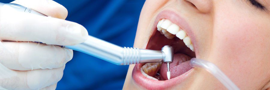 Dental Filling in Islamabad