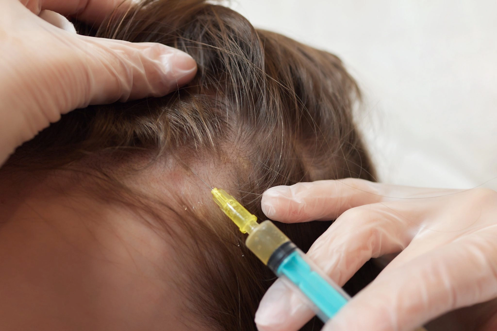Acell PRP Treatment in Abu Dhabi