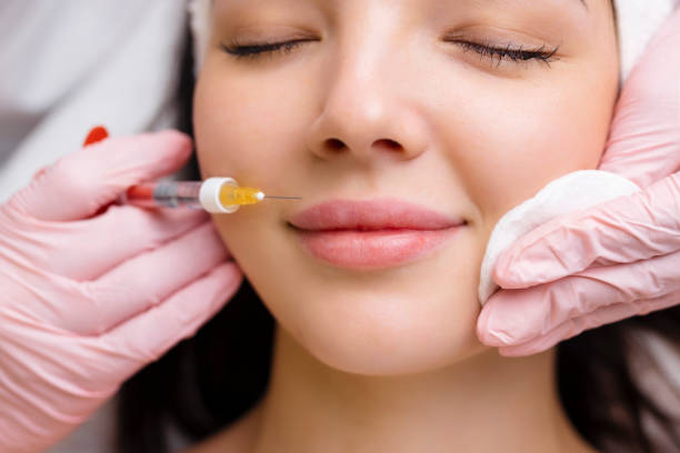 Does Lip Filler Help Reduce the Appearance of Lip Lines