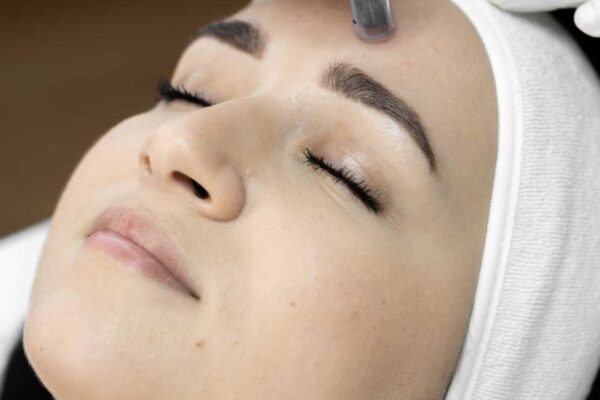 Microneedling for Acne Scars Abu Dhabi