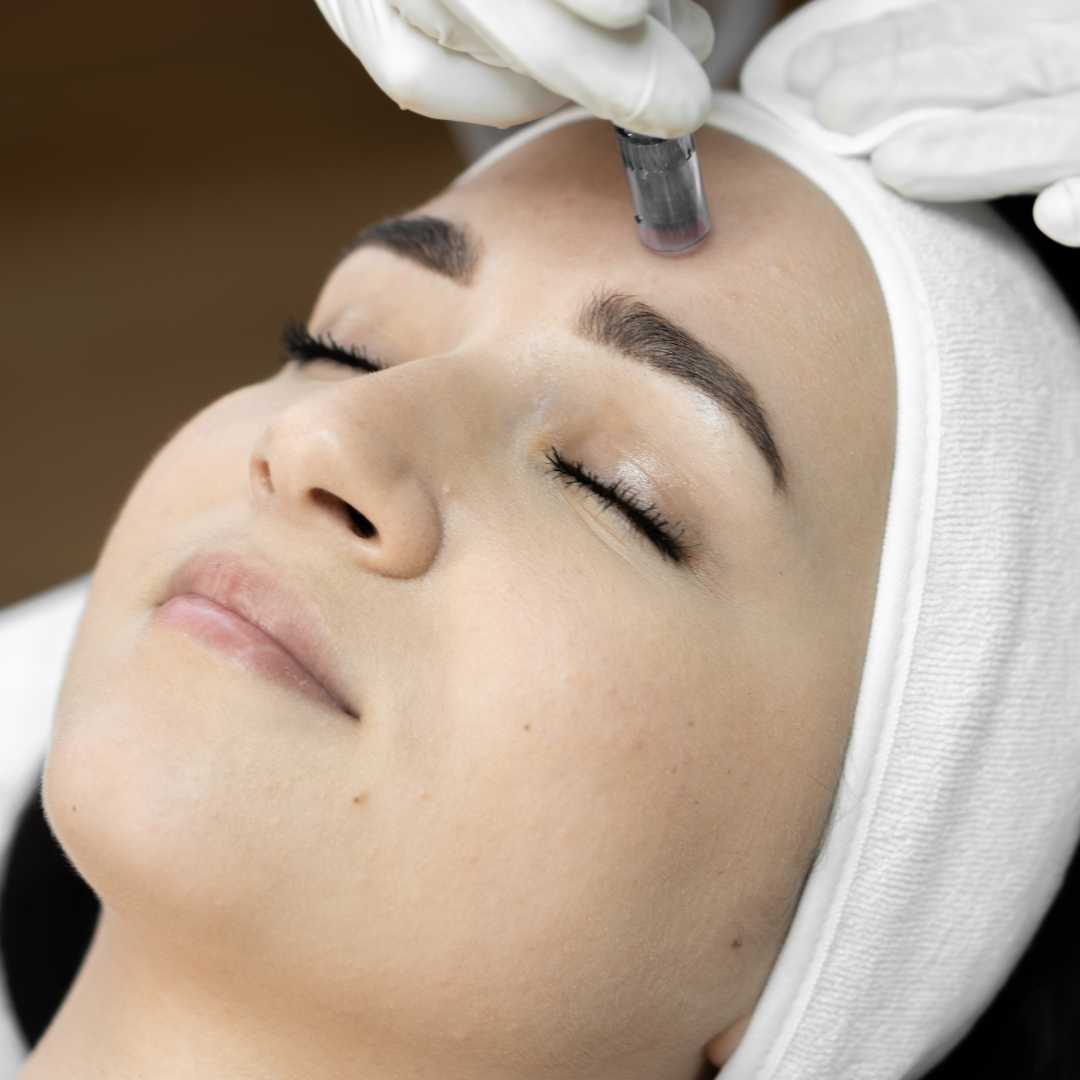Microneedling for Acne Scars Abu Dhabi
