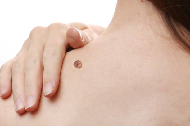 Does Warts Removal Treatment Work Permanently