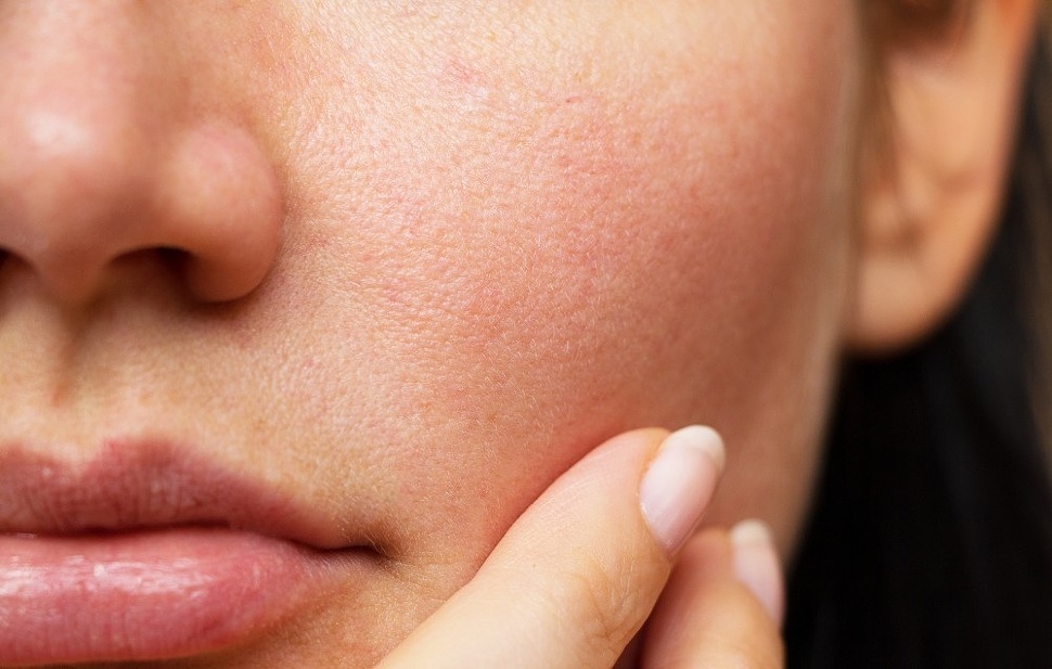 Dry Skin Treatment in Islamabad