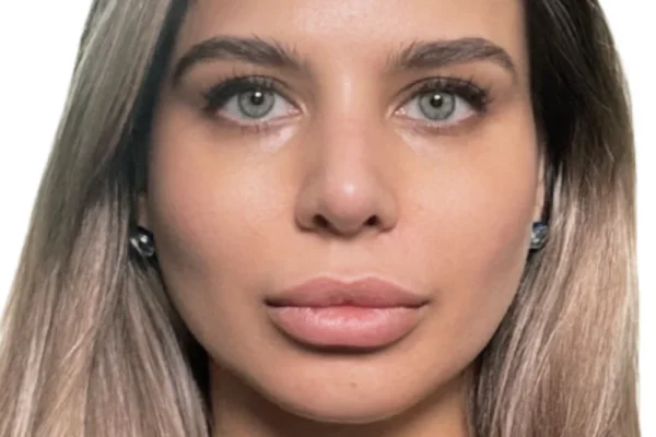 Enhance Facial Harmony with Rhinoplasty