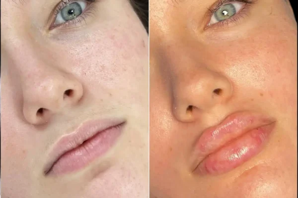 Fillers in Dubai