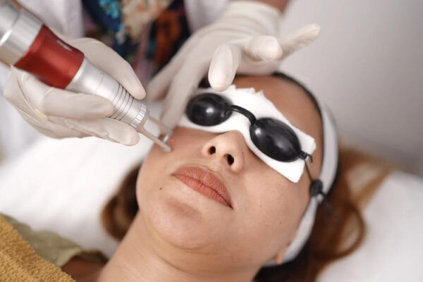 Fractional CO2 Skin Resurfacing in Islamabad