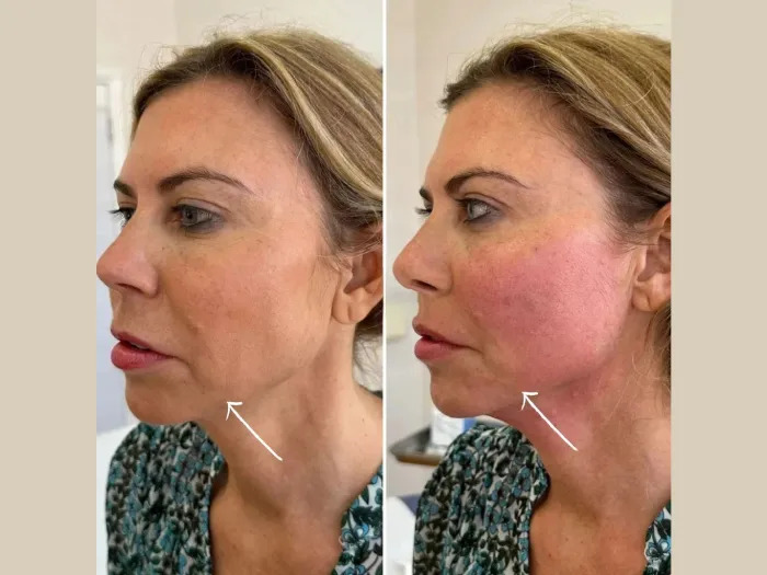 Best Plastic Surgeon in dubai Providing Advanced Endolift Anti Aging