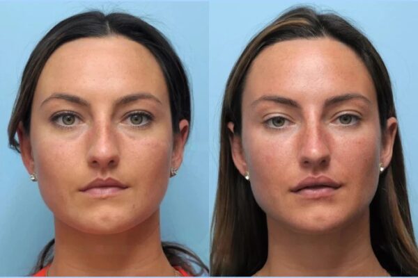 Best Aesthetic Clinics in Dubai Specialize Thread Lift for Firming Skin