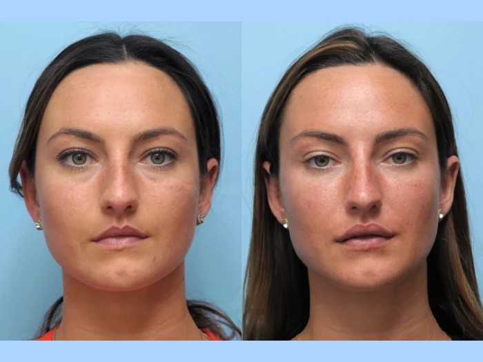 Best Aesthetic Clinics in Dubai Specialize Thread Lift for Firming Skin