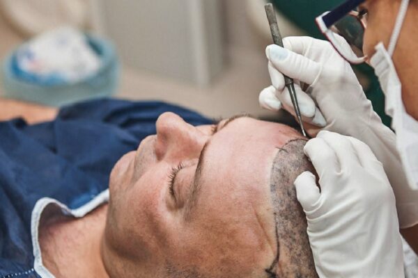Hair Transplant in Islamabad